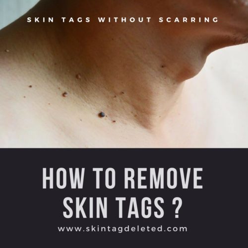 Revitol Skin Tag Remover: Skin Tags Without Scarring !