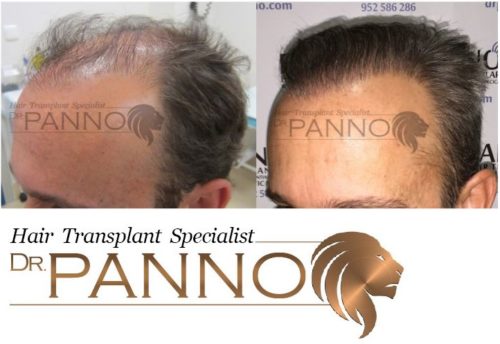 HAIR TRANSPLANT AND HAIR RESTORATION TO CHANGE YOUR LIFE!